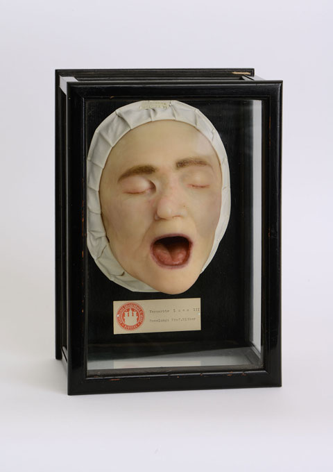 Wachsmoulage eines Gesichts mit vernarbter Lues (Syphilis) von Max Broyer, um 1925